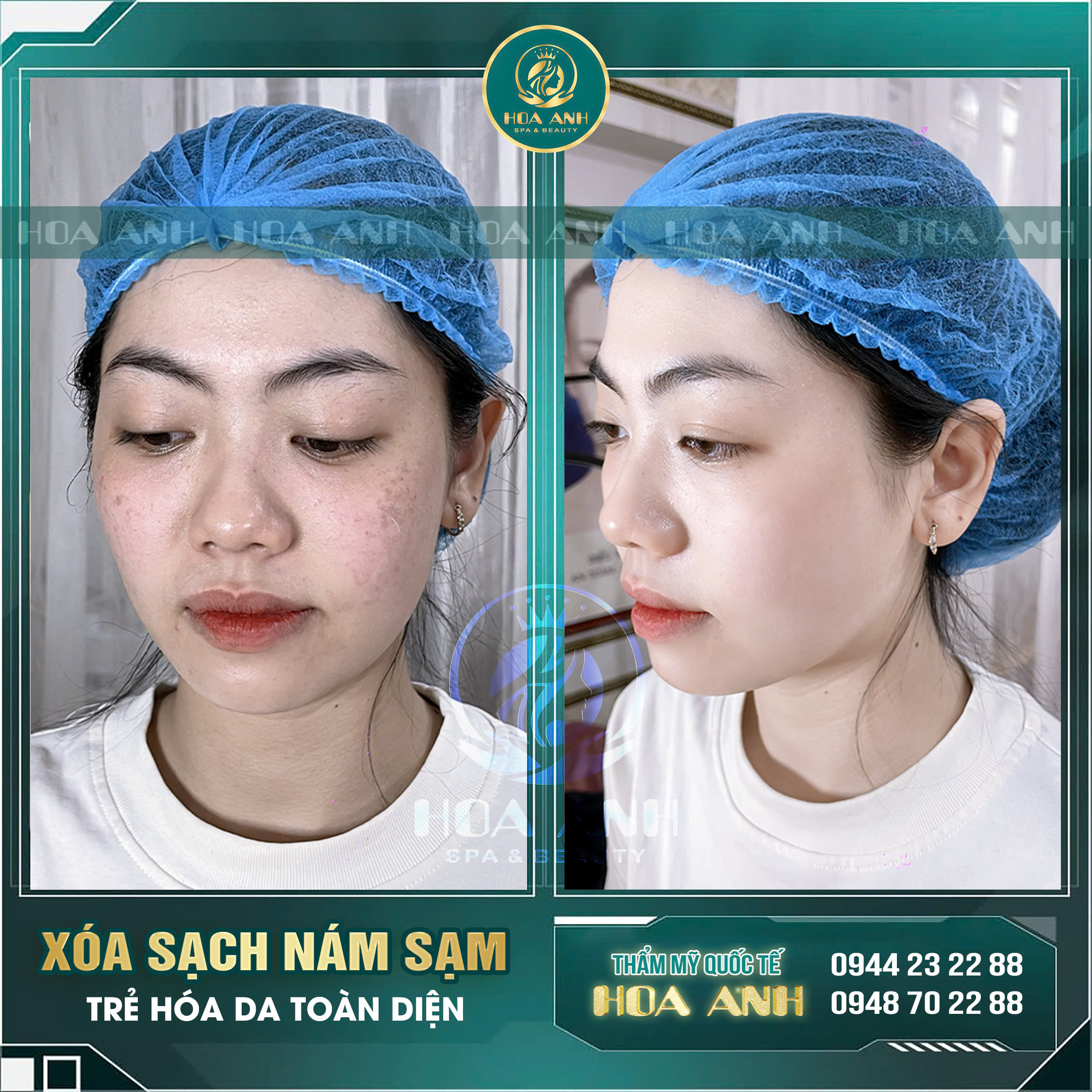 trị nám