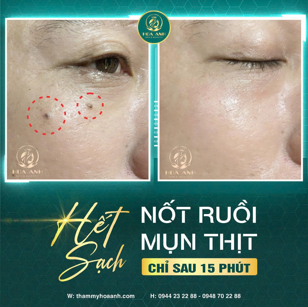 laser xóa nốt ruồi, mụn thịt