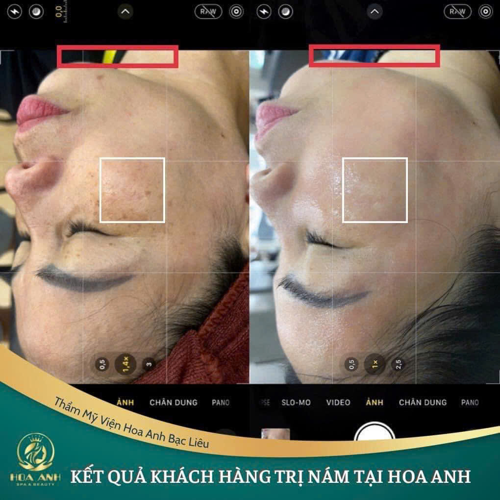 điều trị nám