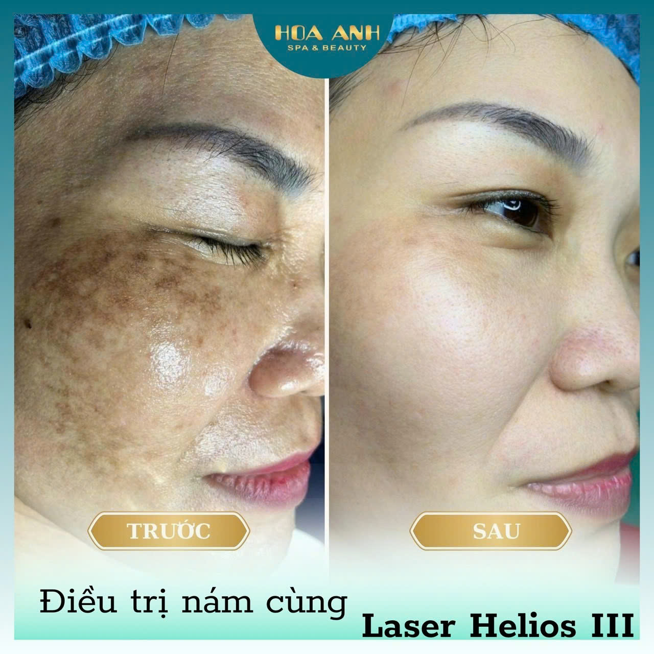 điều trị nám