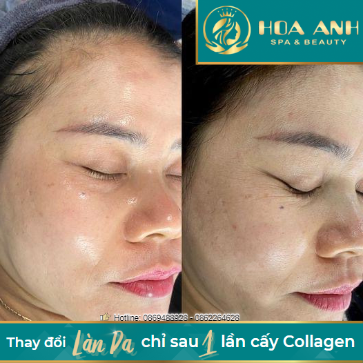 điều trị nám
