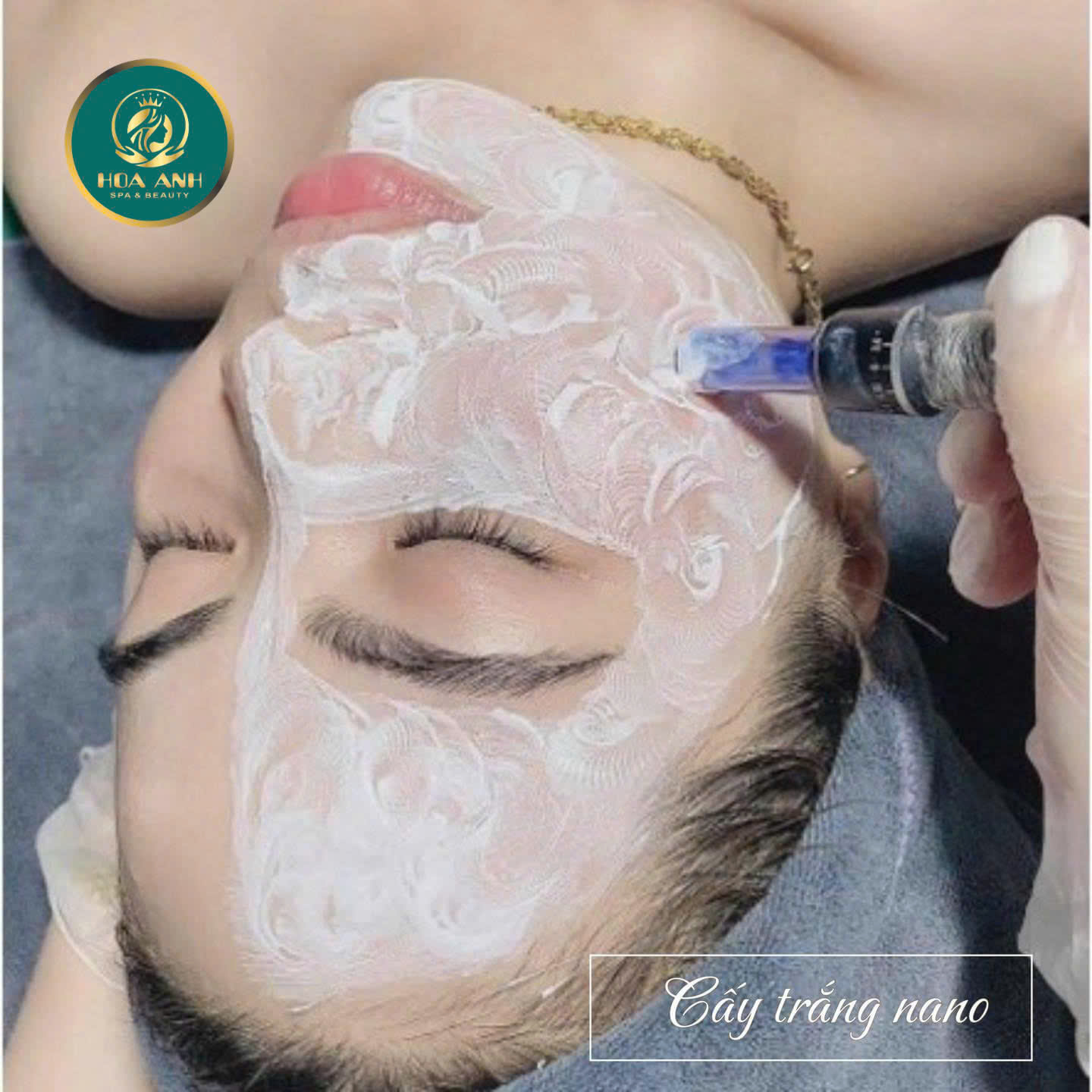 cấy trắng nano