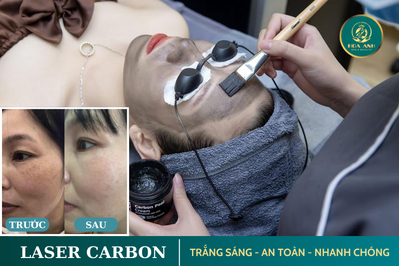 laser cacbon