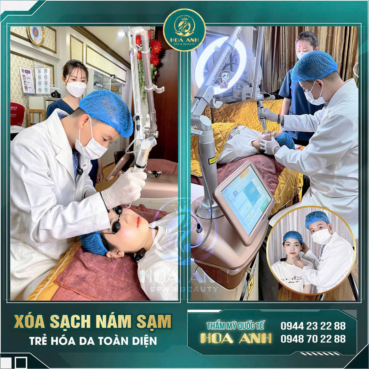 điều trị nám