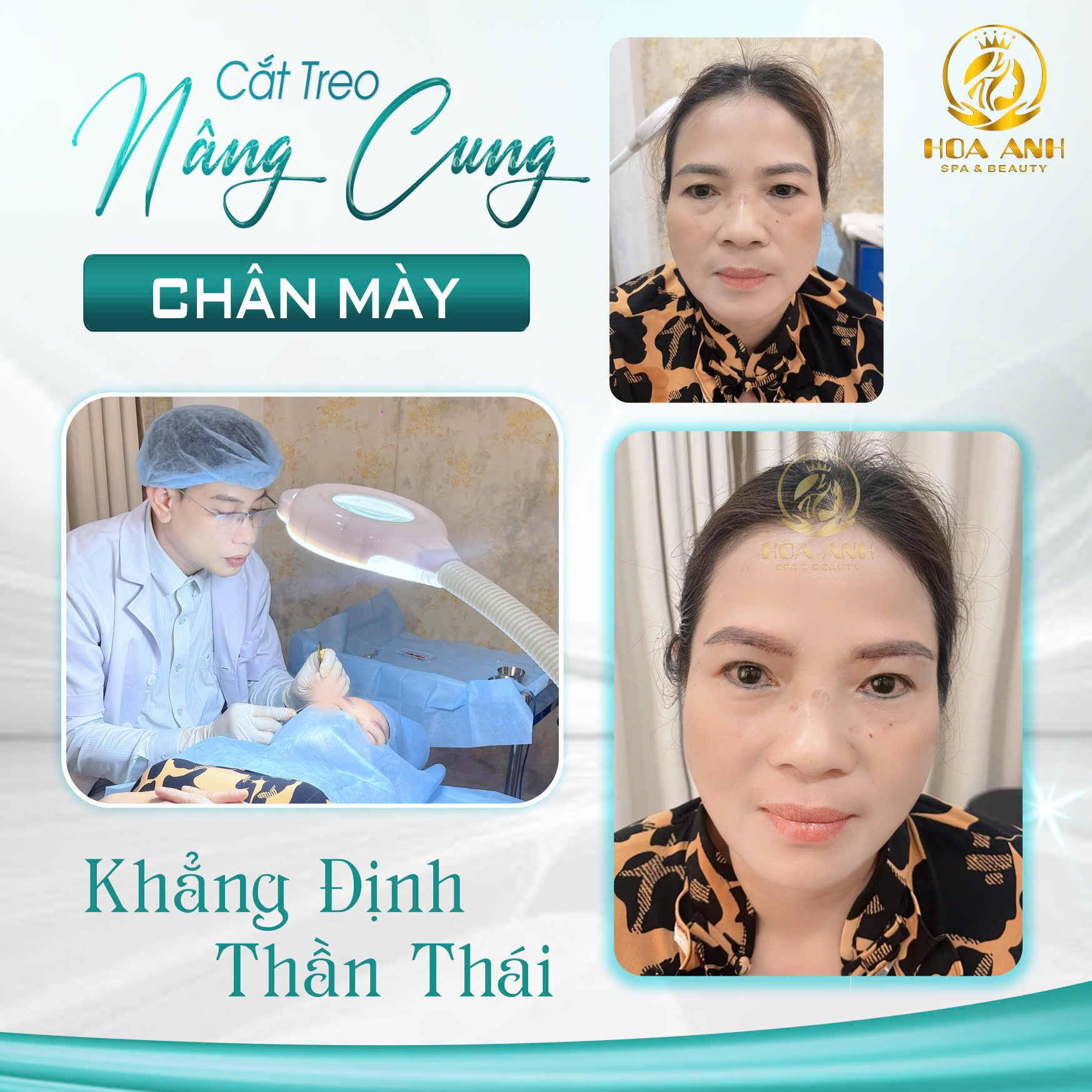 cắt treo nâng cung