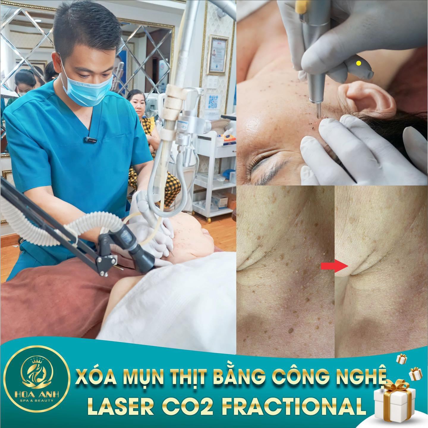 laser xóa nốt ruồi, mụn thịt