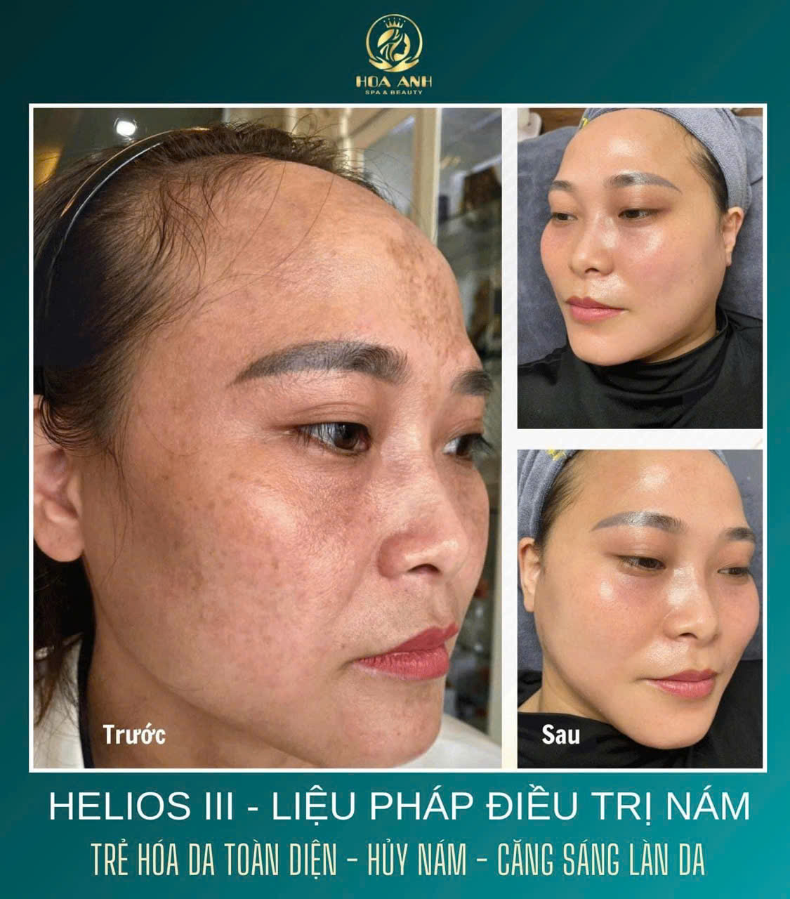 điều trị nám