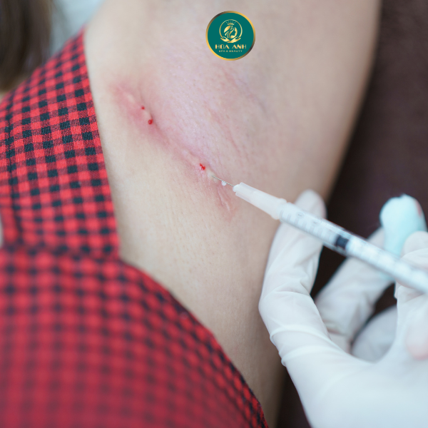 phương pháp tiêm trị sẹo