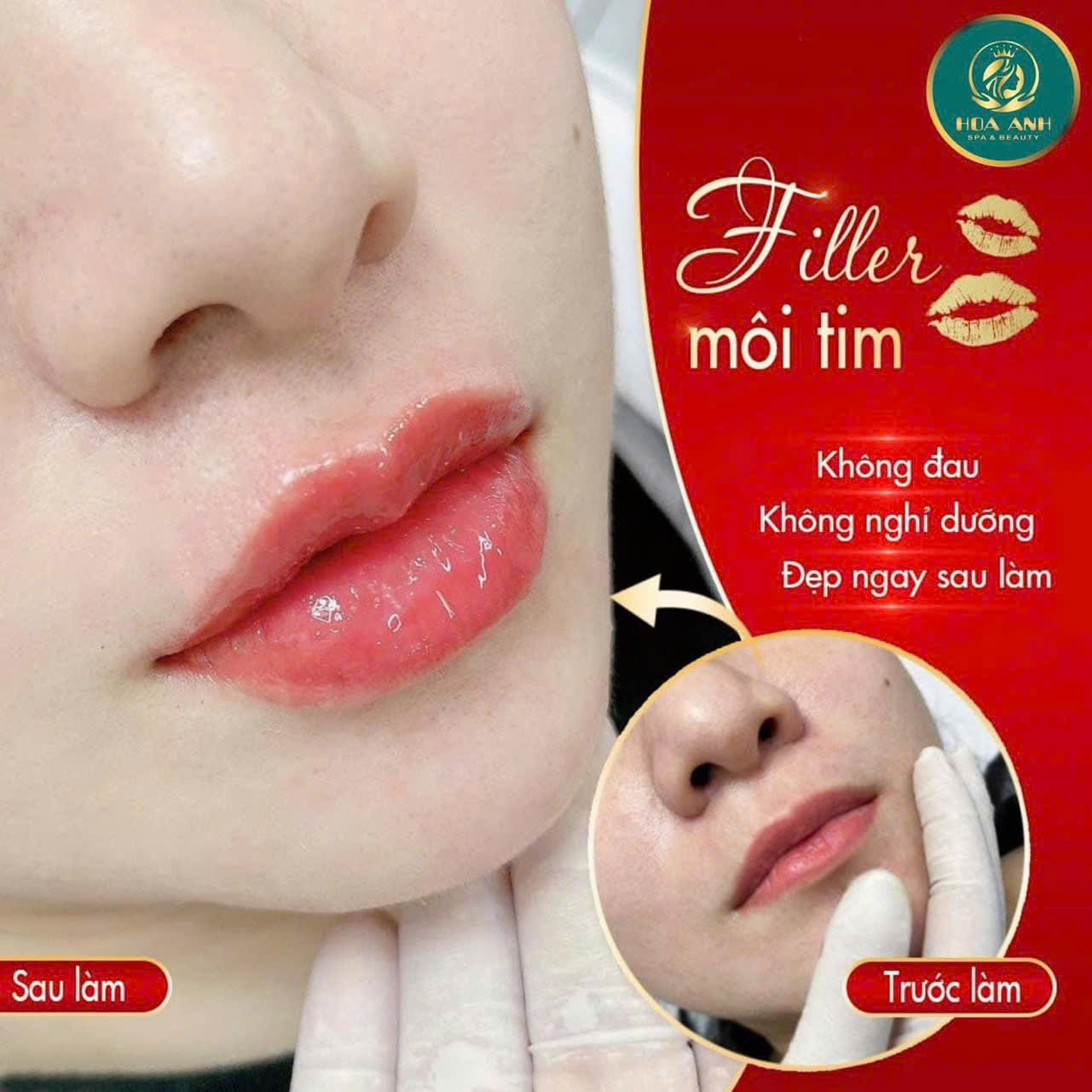 tiêm môi baby