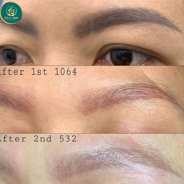 laser xóa mày hỏng