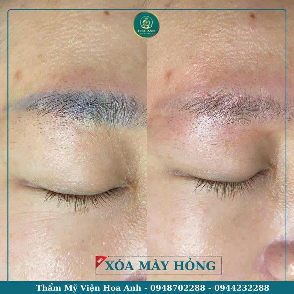 laser xóa mày