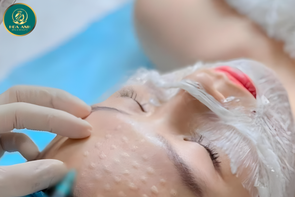 cấy meso căng bóng