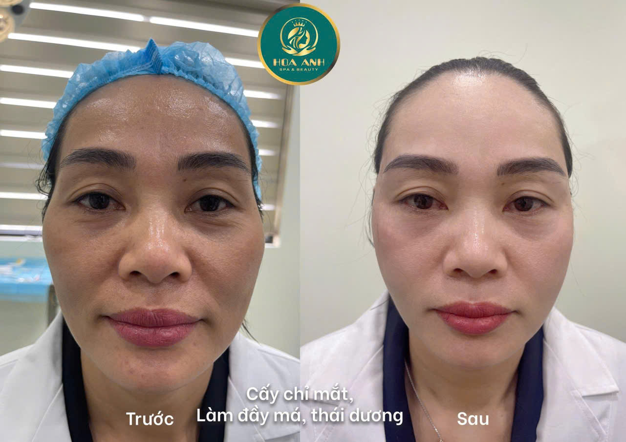 xóa rãnh cười