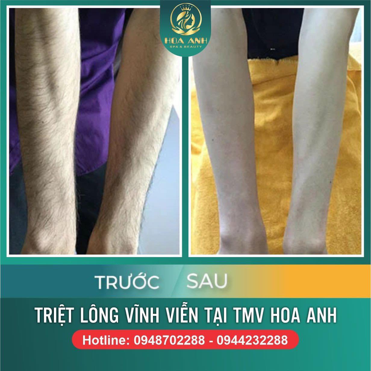 triệt lông vĩnh viên