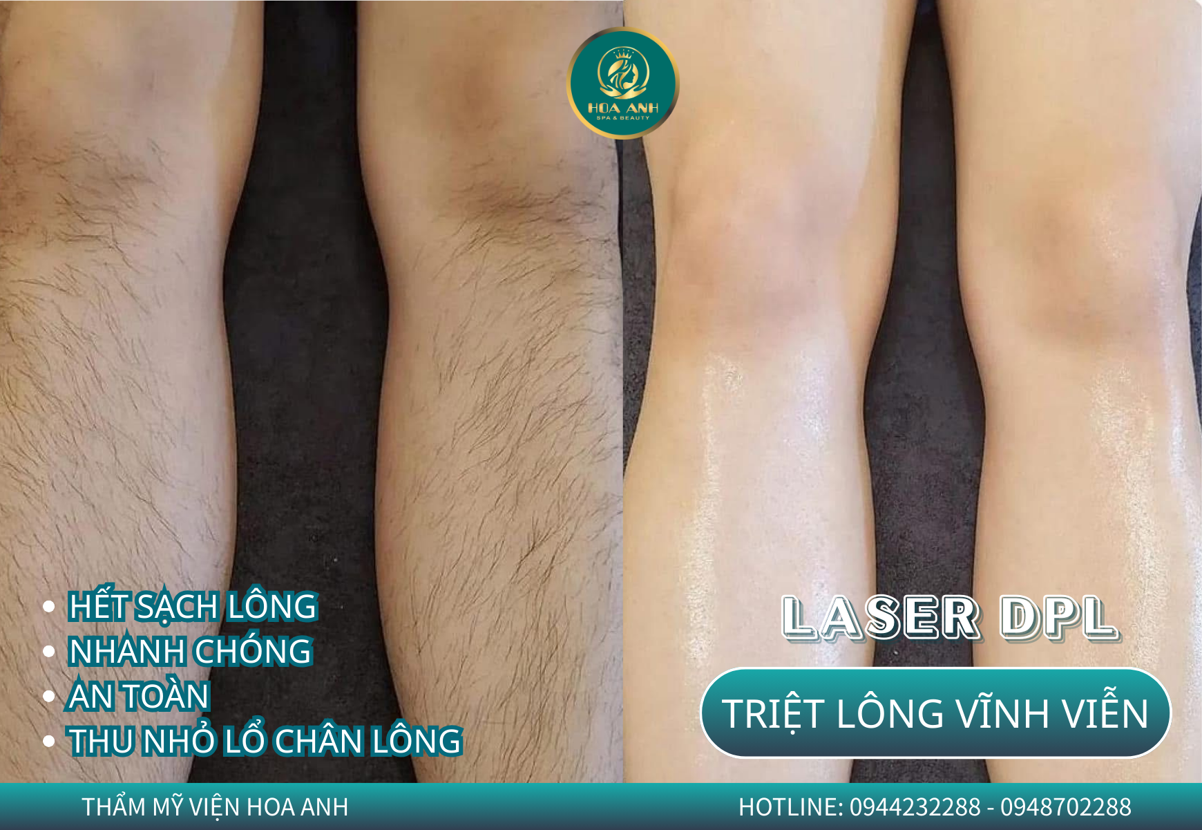 triệt lông vĩnh viên