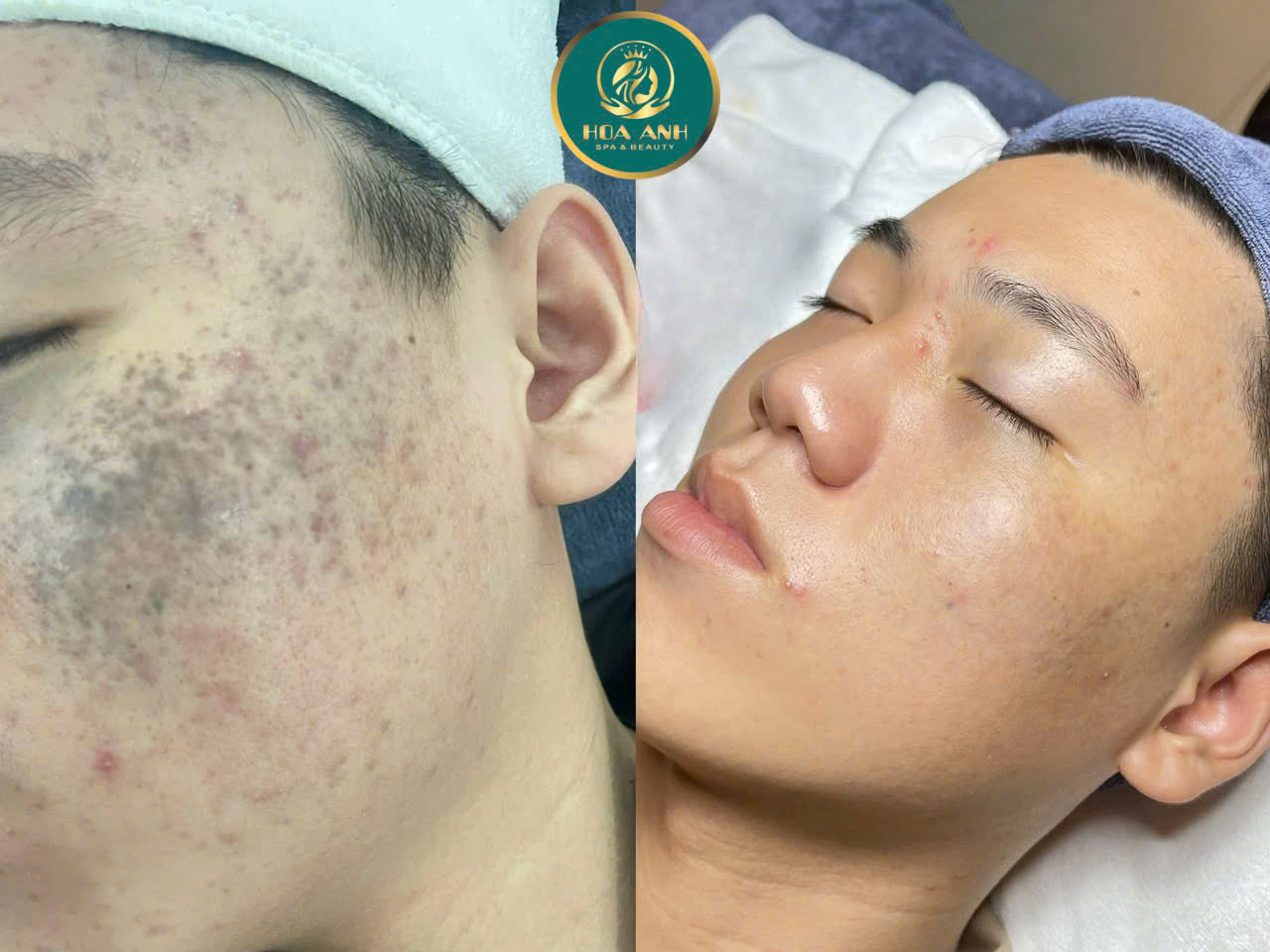 xóa bớt bẩm sinh