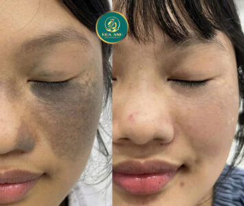 xóa bớt bẩm sinh