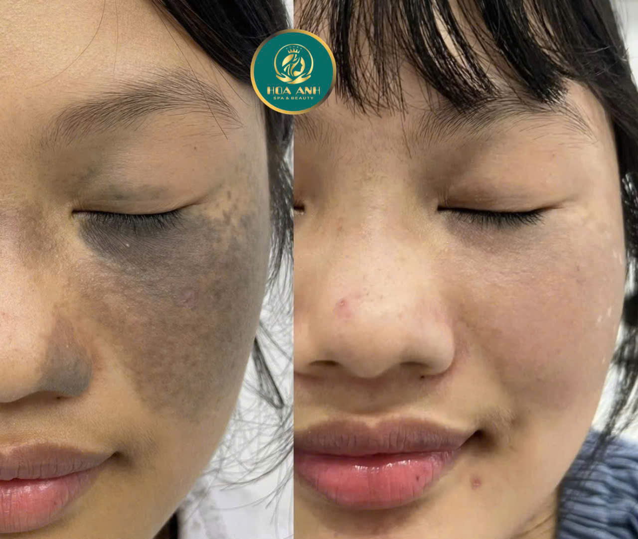 xóa bớt bẩm sinh