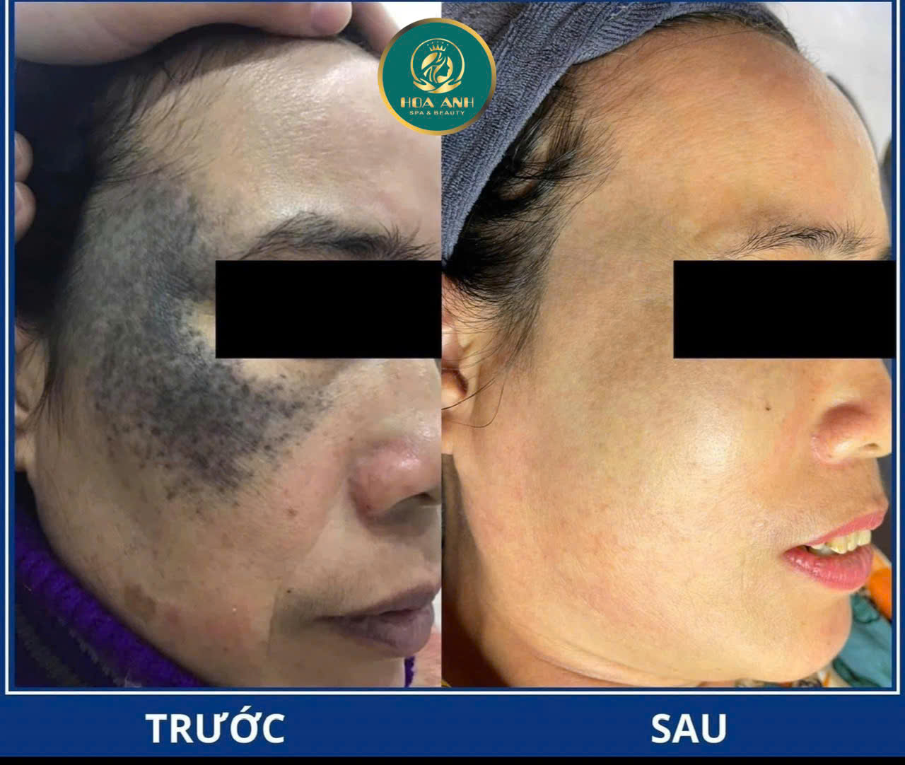 xóa bớt bẩm sinh