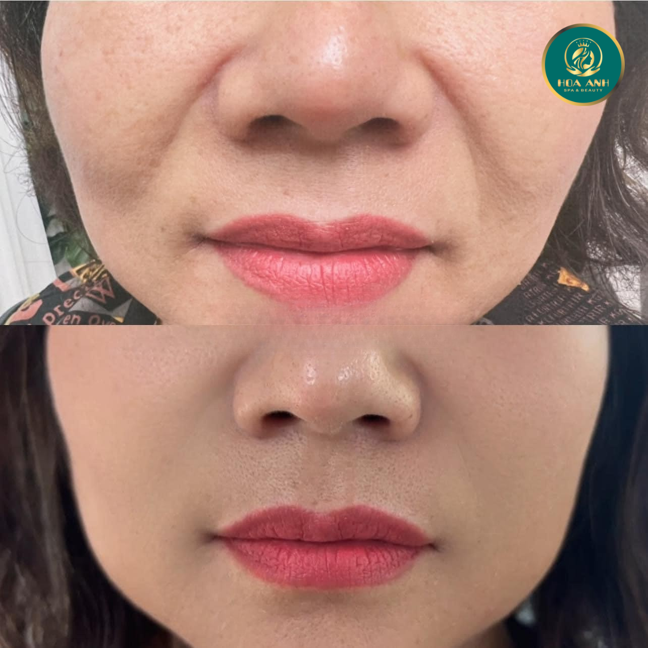 xóa rãnh cười