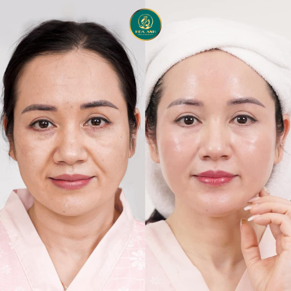 xóa rãnh cười