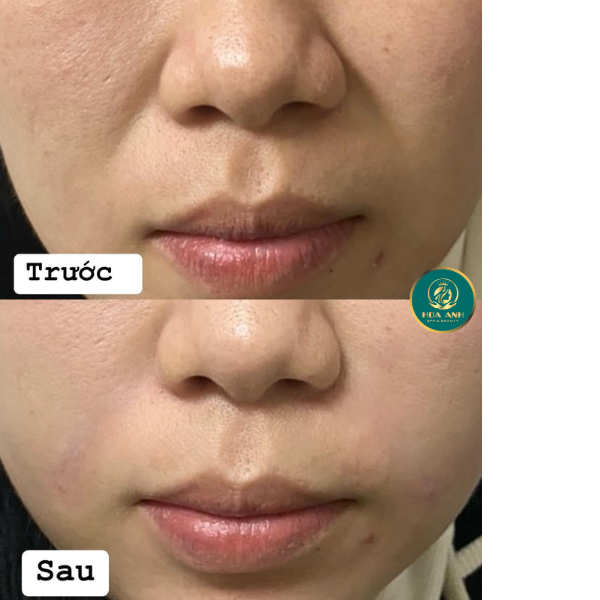 xóa rãnh cười