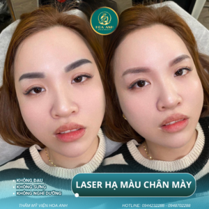 laser xóa chân mày