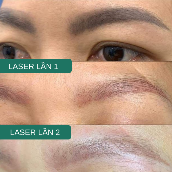 laser xóa chân mày