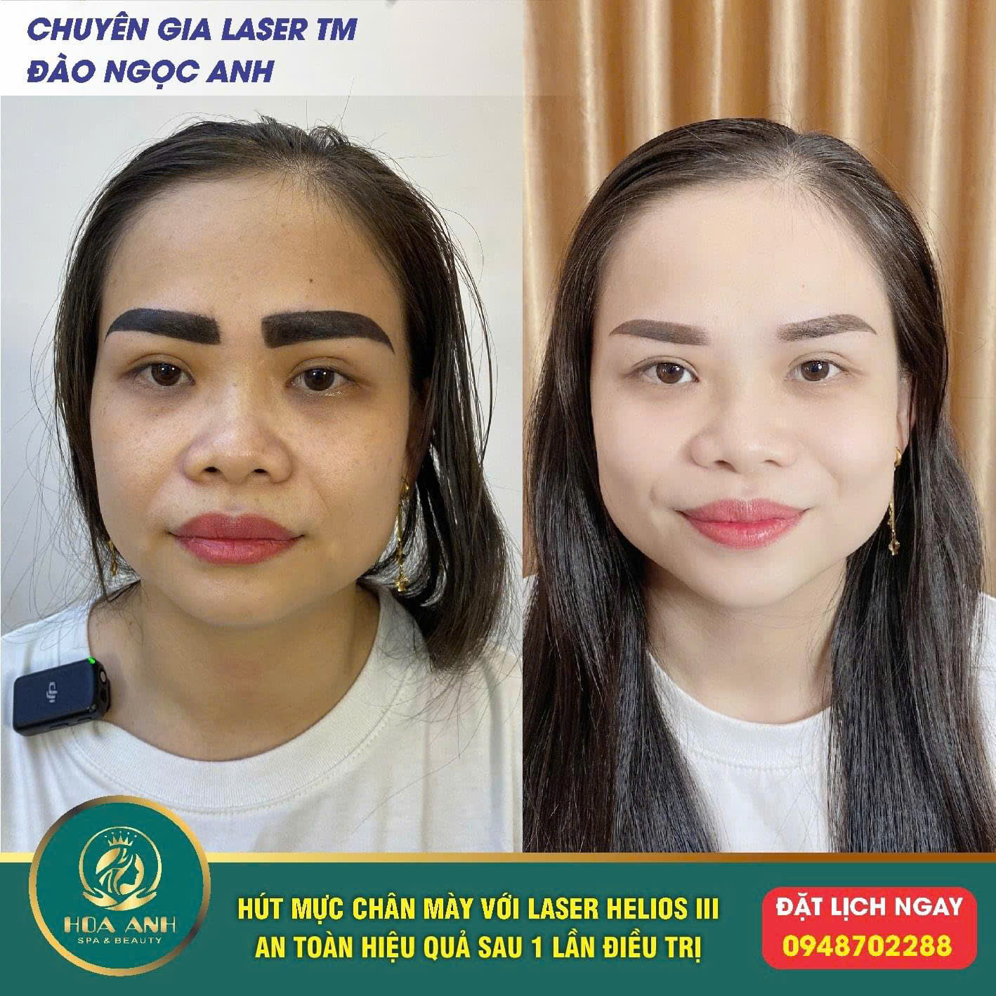 laser xóa chân mày