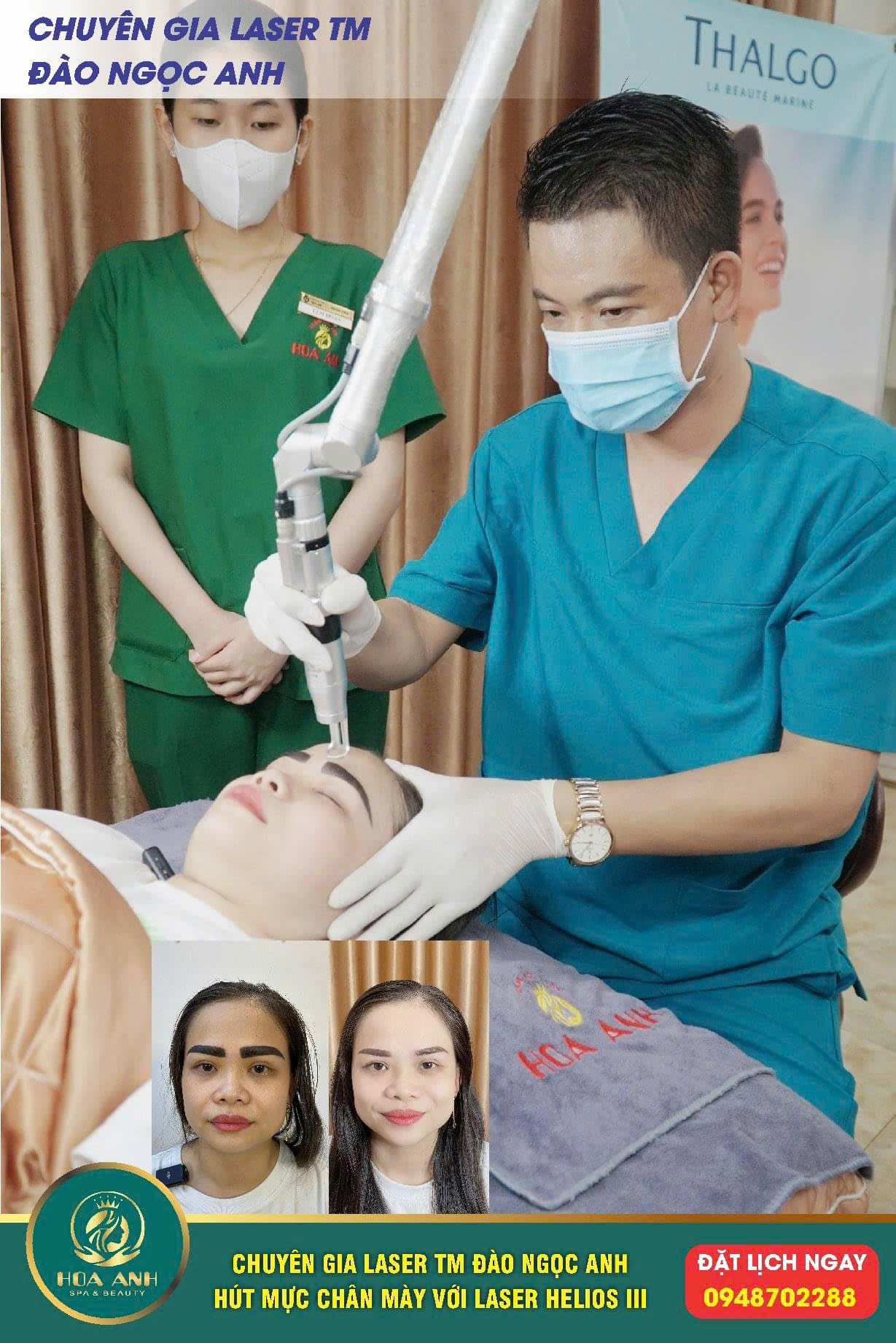 laser xóa chân mày