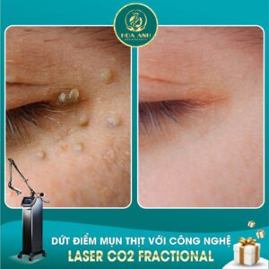 laser xóa mụn thịt