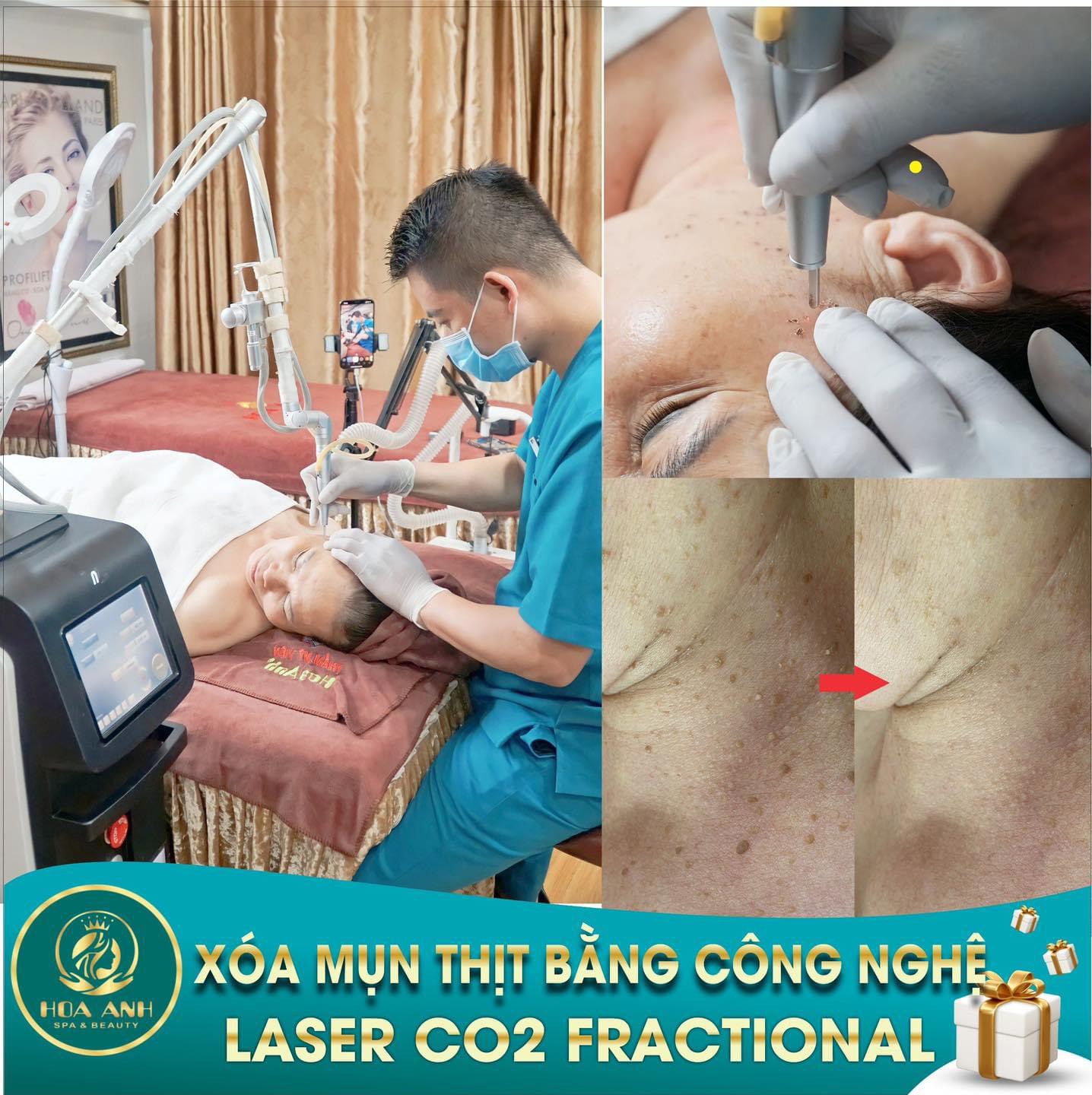 laser mụn thịt