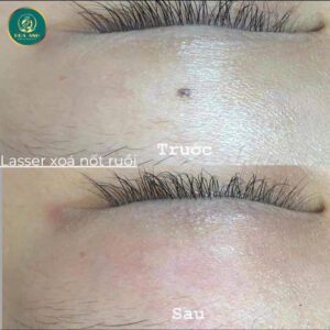 laser nốt ruồi