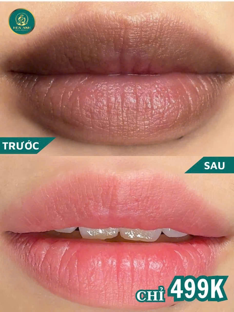 laser xử lý thâm môi