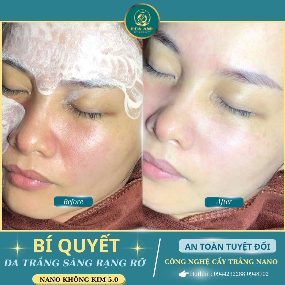 cấy trắng da