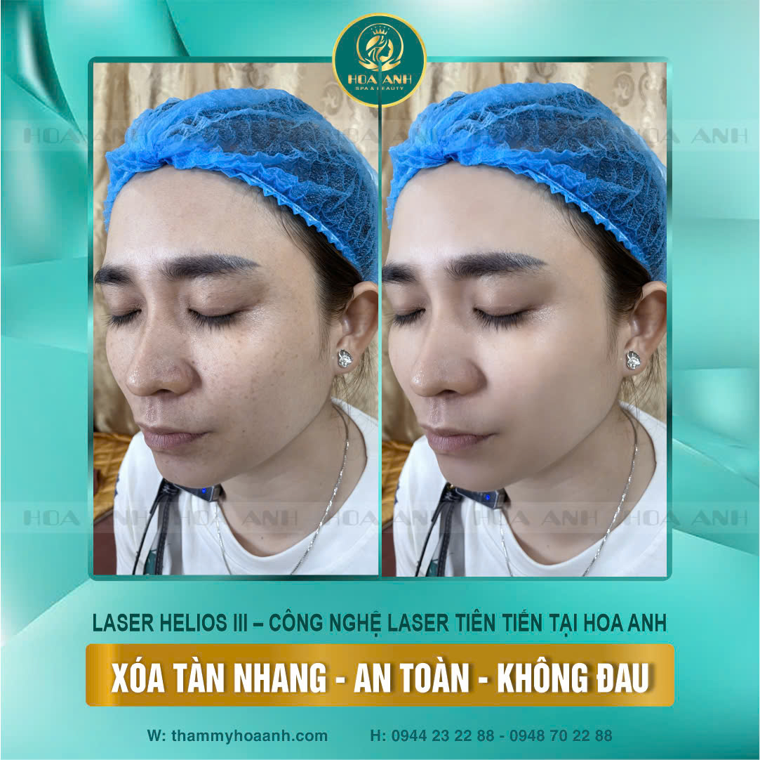 laser mụn thịt