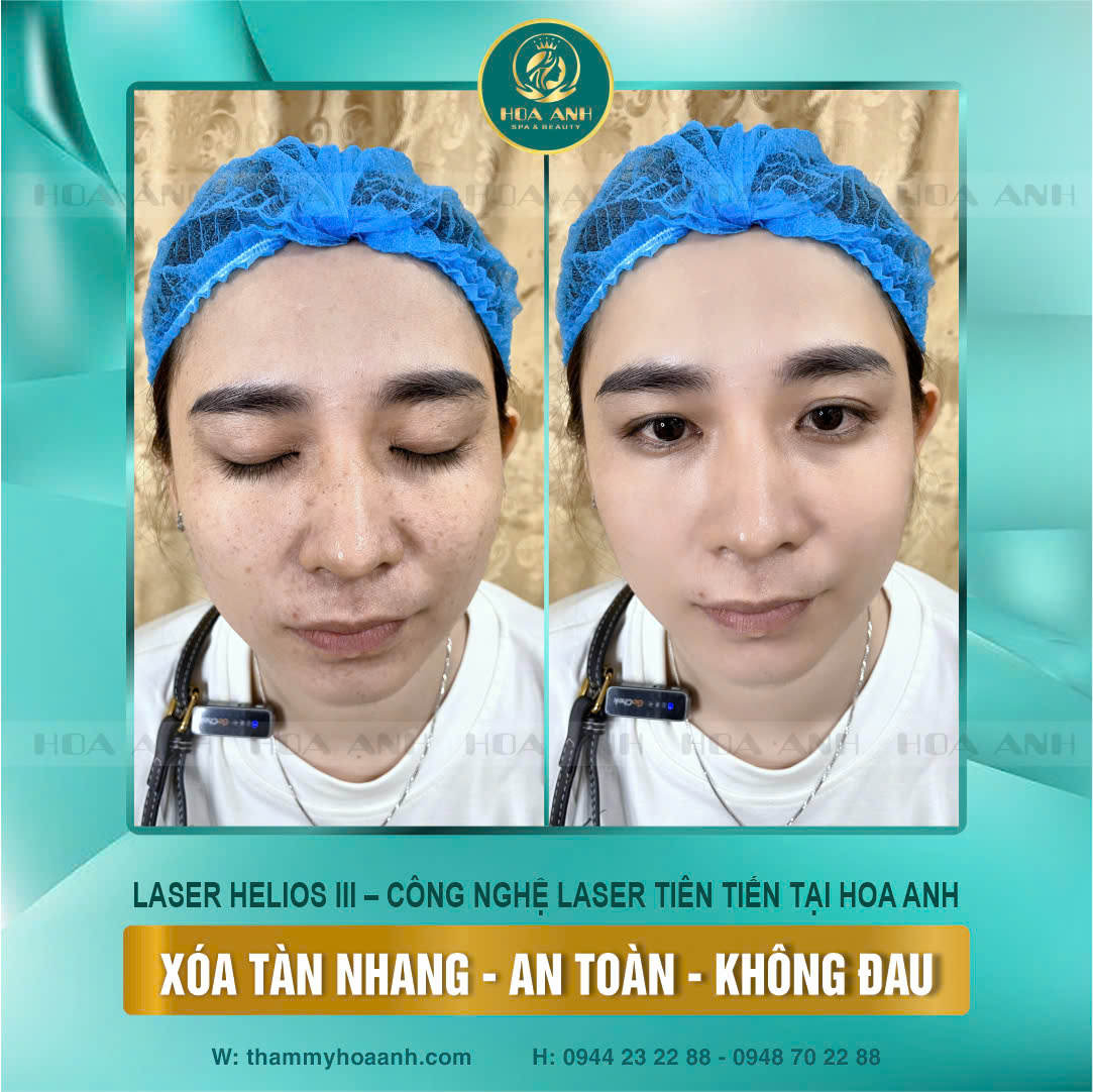 laser mụn thịt