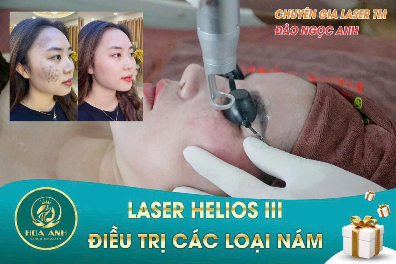 laser xóa nám