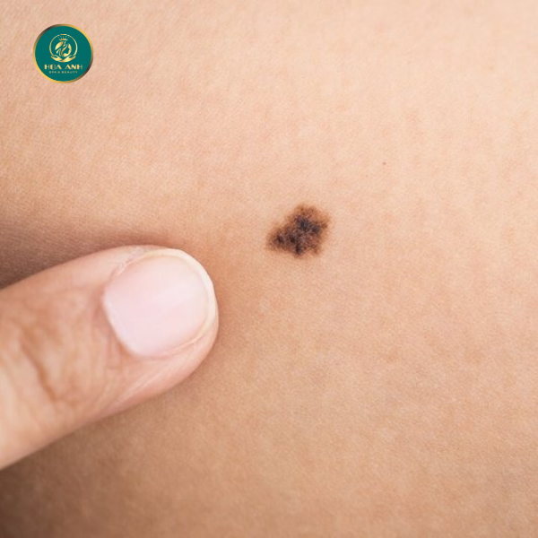 laser xóa nốt ruồi