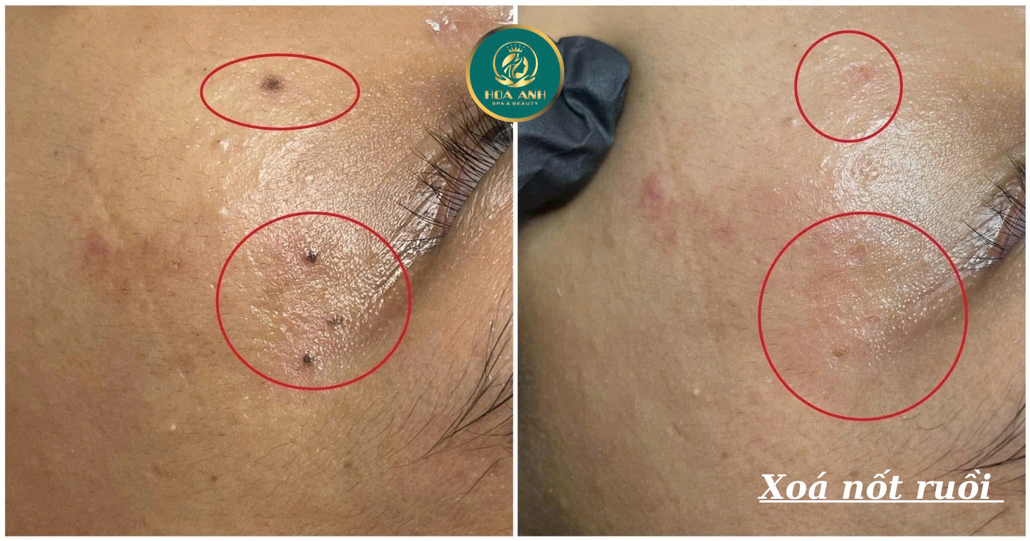 laser xóa nốt ruồi