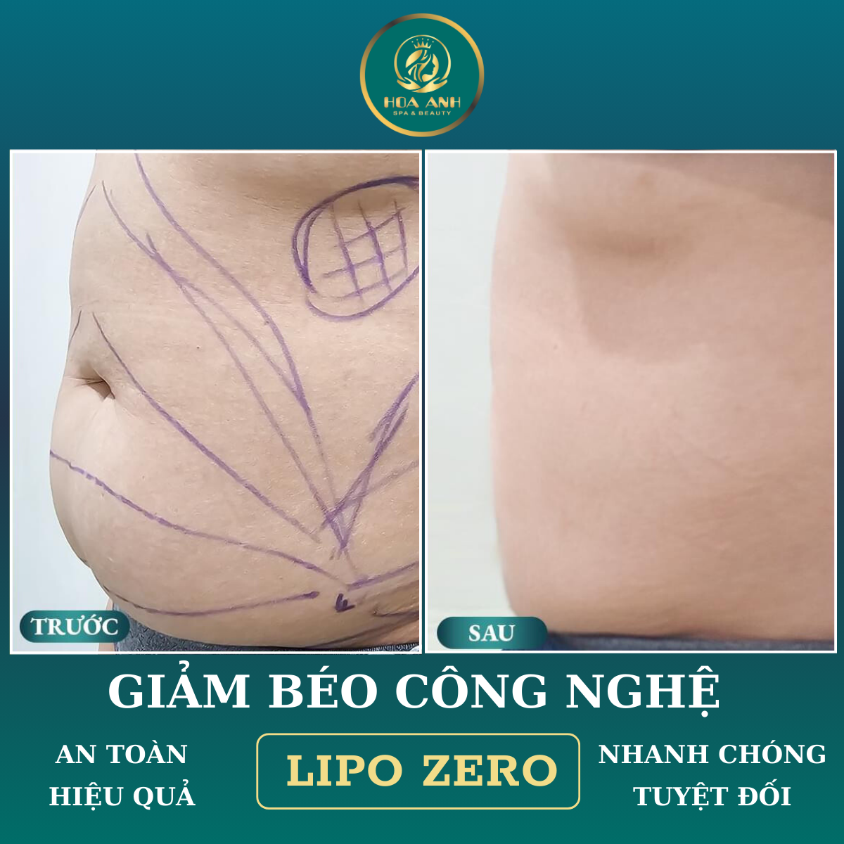 giảm béo cấp tốc