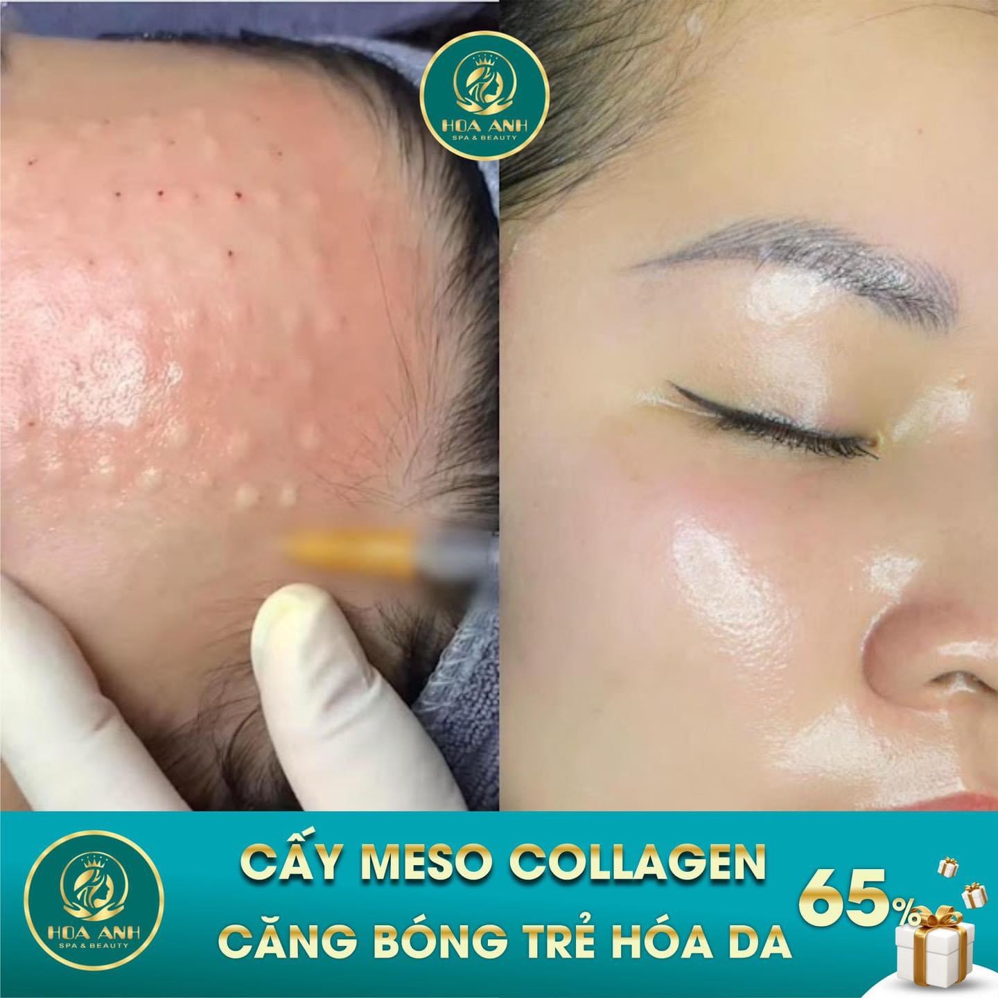 cấy meso căng bóng da