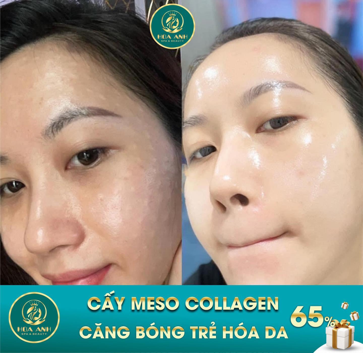 cấy meso căng bóng da