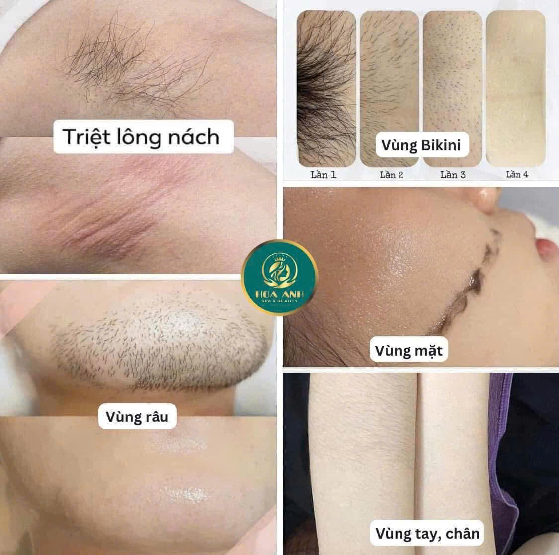 triệt lông vĩnh viễn