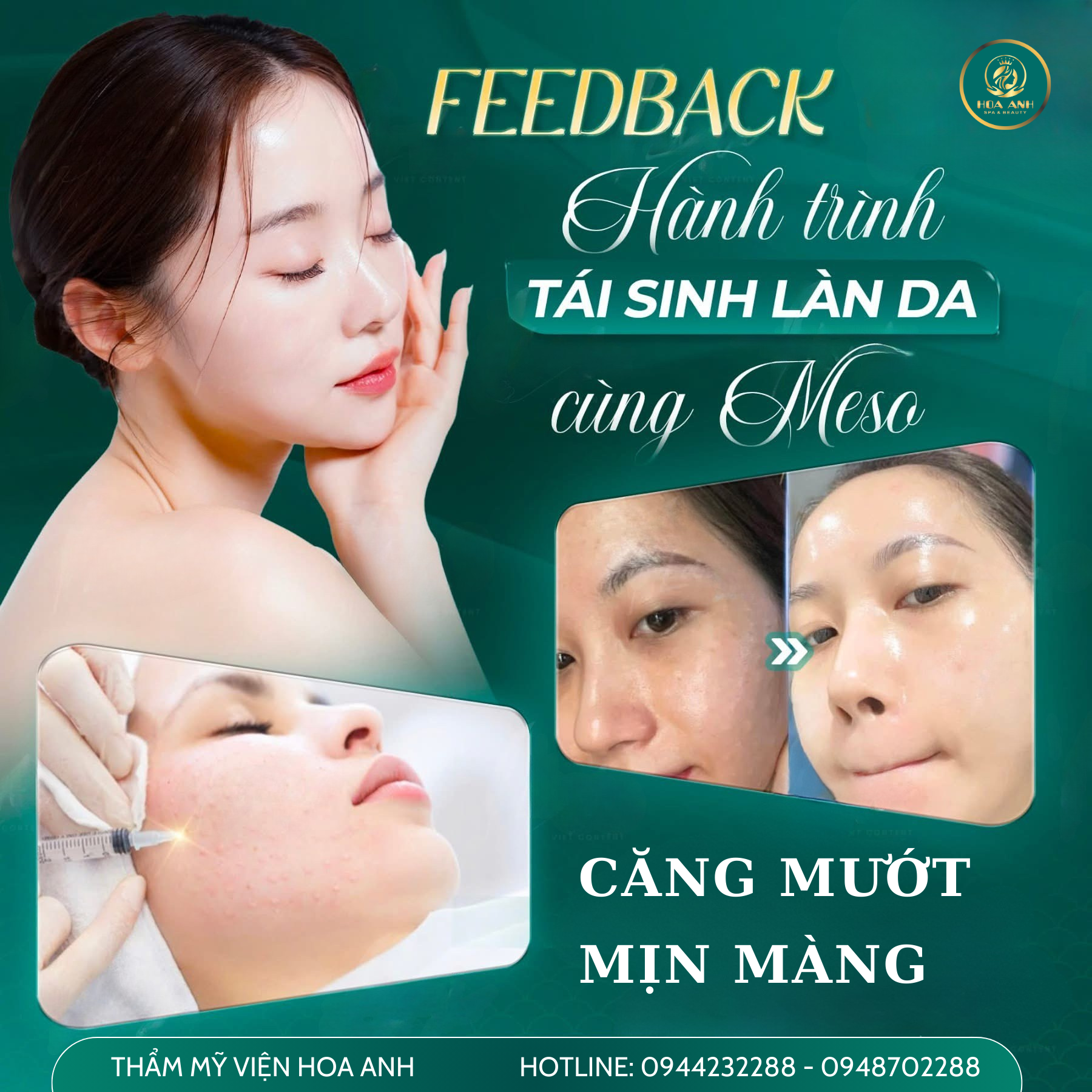 cấy meso căng bóng da