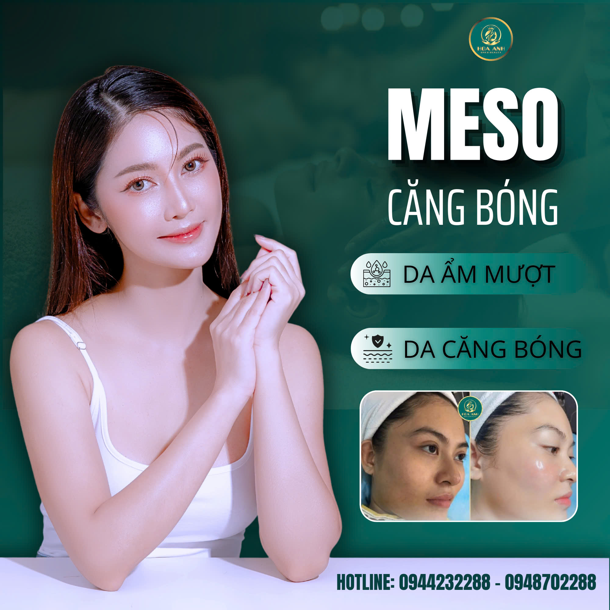 cấy meso căng bóng da