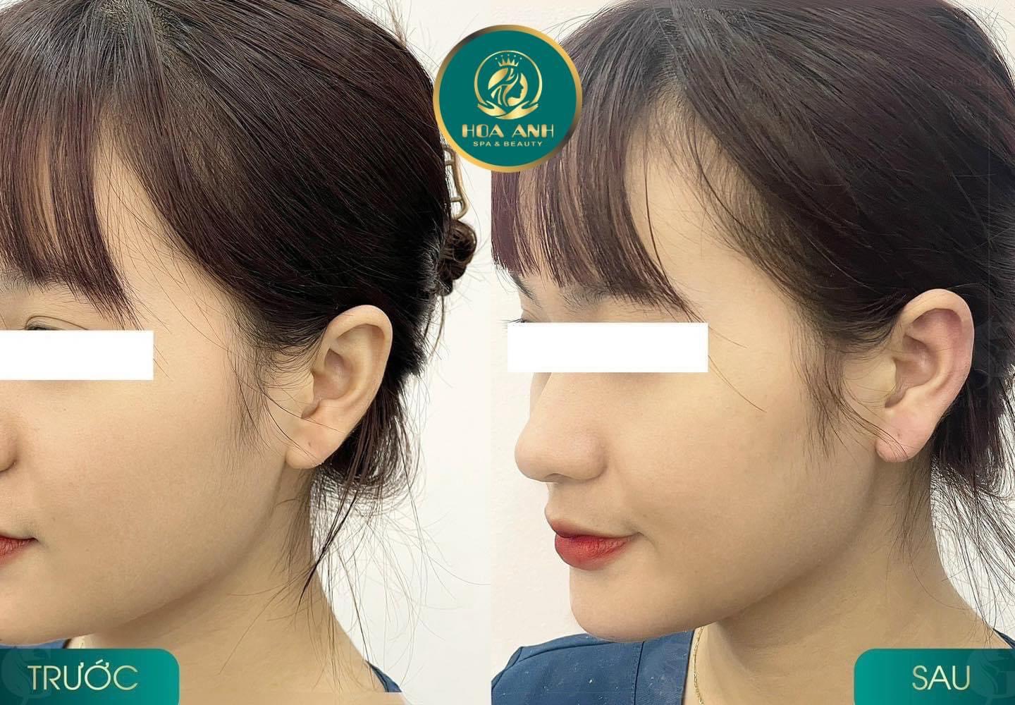 tiêm tai tài lộc