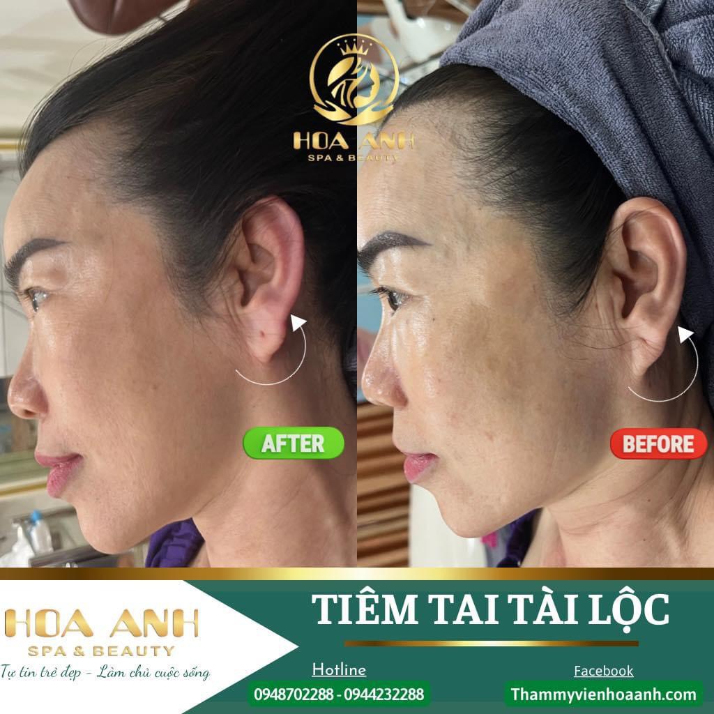 tiêm tai tài lộc