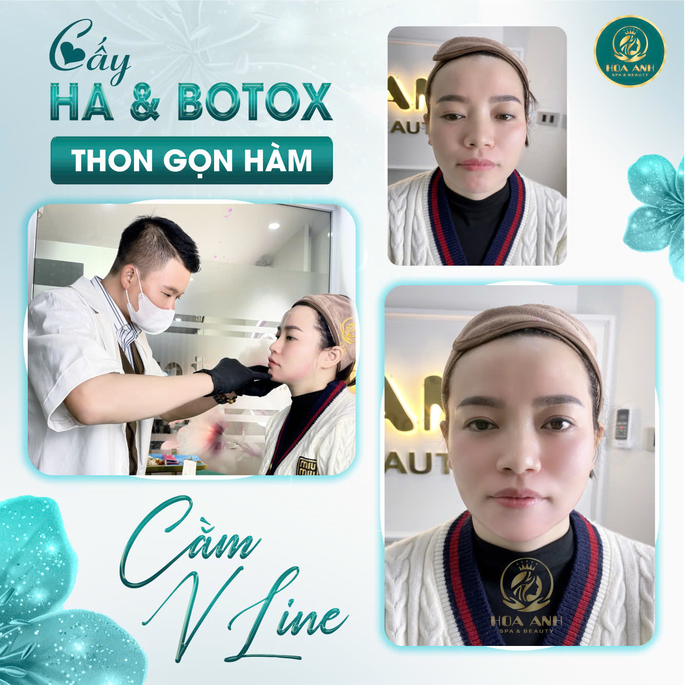 tiêm cằm vline