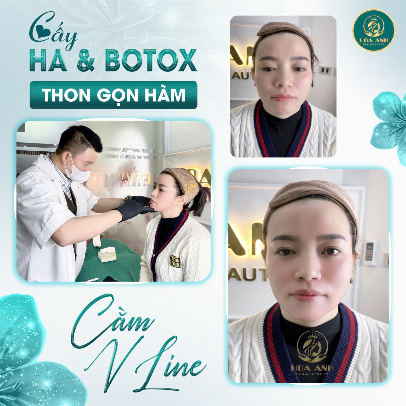 tiêm cằm vline